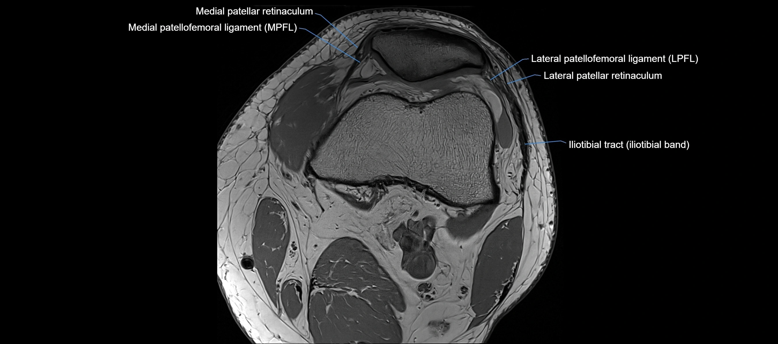 MRI Knee axial  ligaments cross sectional anatomy 3T  radiology  image-img-03001-00012.webp